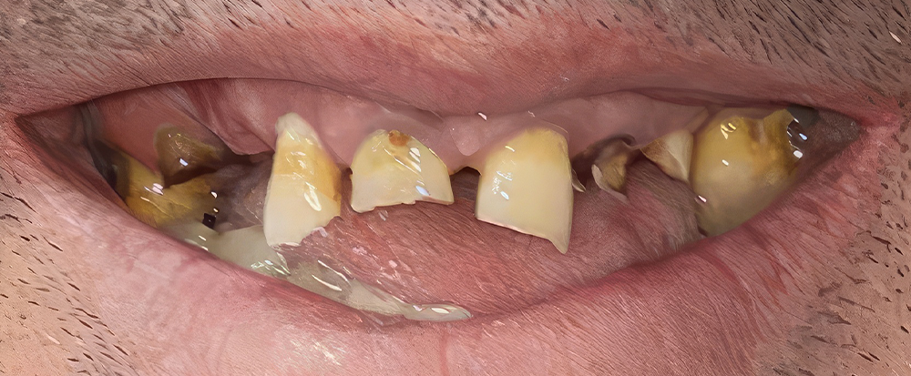 Antes